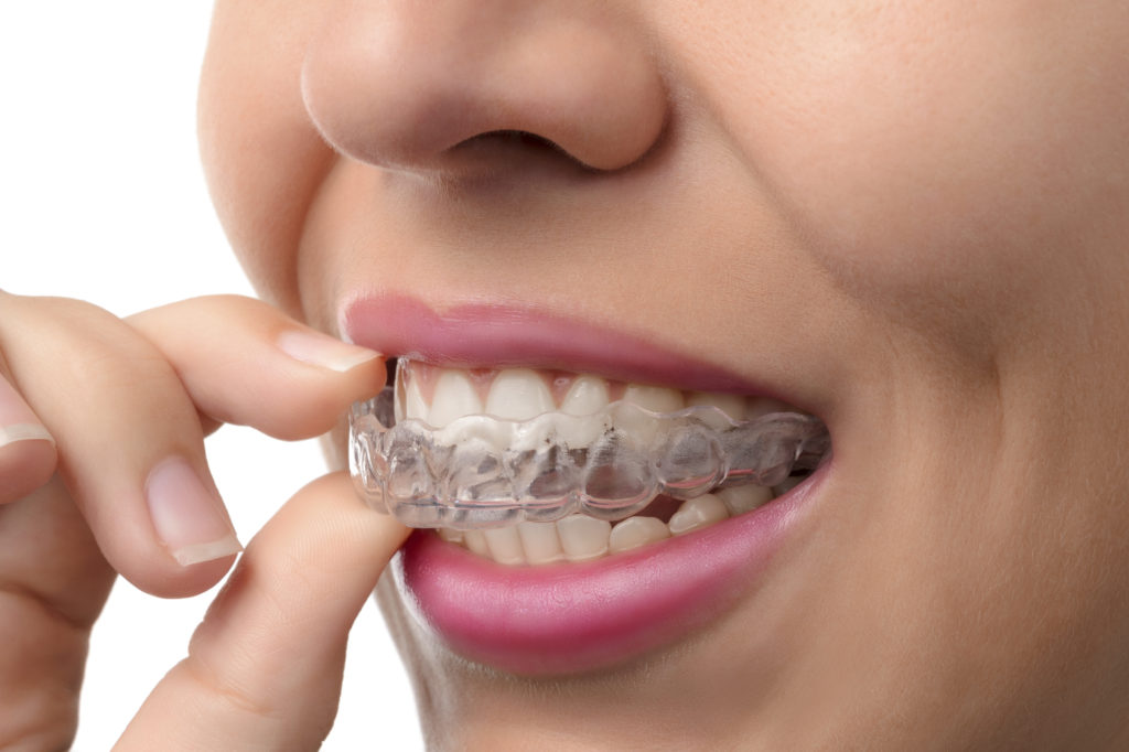 Woman wearing orthodontic silicone trainer. Invisible braces